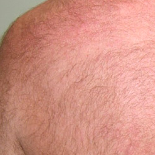 lightsheer-duet lightsheer-duet